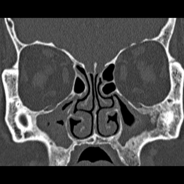 File:Chronic maxillary sinusitis (Radiopaedia 27879-28116 Coronal bone window 23).jpg