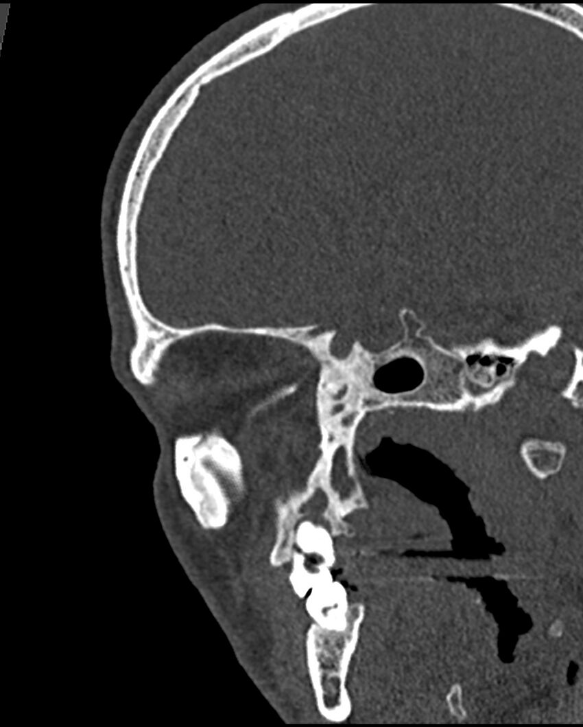 Chronic maxillary sinusitis caused by a foreign body (Radiopaedia 58521-65676 Sagittal bone window 53).jpg