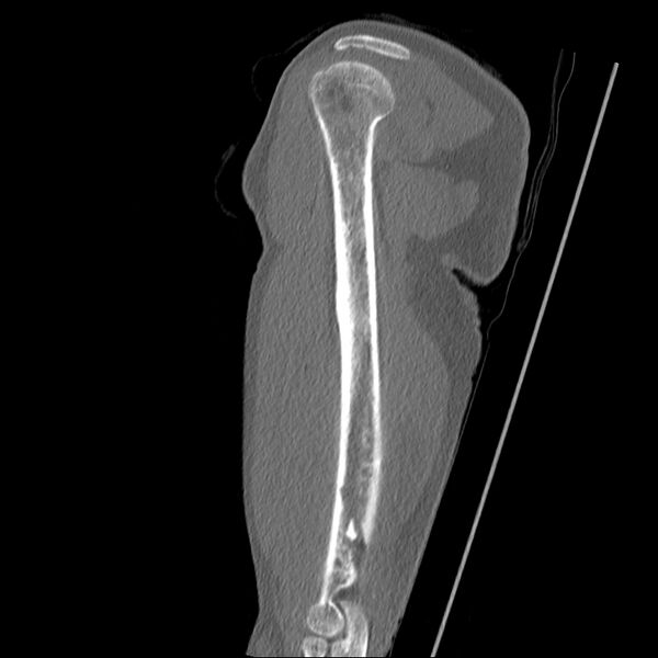 File:Chronic osteomyelitis (Radiopaedia 67597-76998 Sagittal bone window 13).jpg