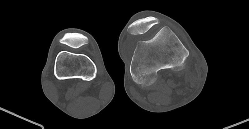 File:Chronic osteomyelitis (with sequestrum) (Radiopaedia 74813-85822 Axial non-contrast 178).jpg