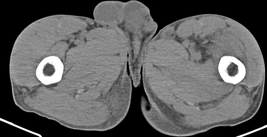 Chronic osteomyelitis (with sequestrum) (Radiopaedia 74813-85822 D 65).jpg
