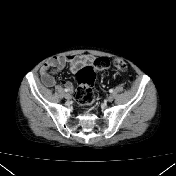File:Chronic pancreatitis (Radiopaedia 23132-23172 B 56).jpg
