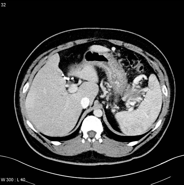 File:Chronic pancreatitis and pseudocysts (Radiopaedia 6724-7935 B 1).jpg