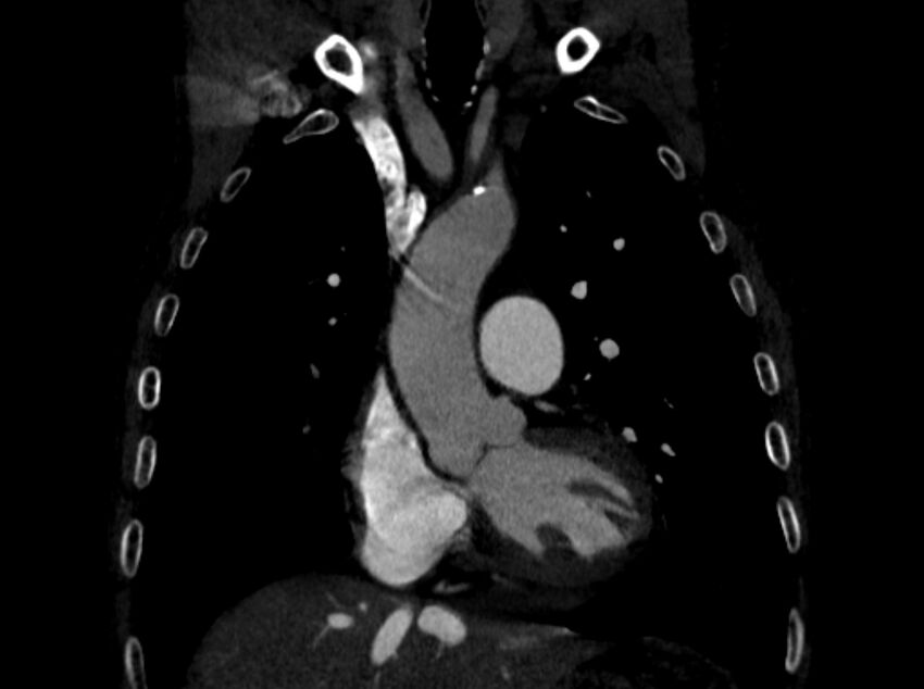 Chronic pulmonary embolism (Radiopaedia 91241-108843 A 36).jpg
