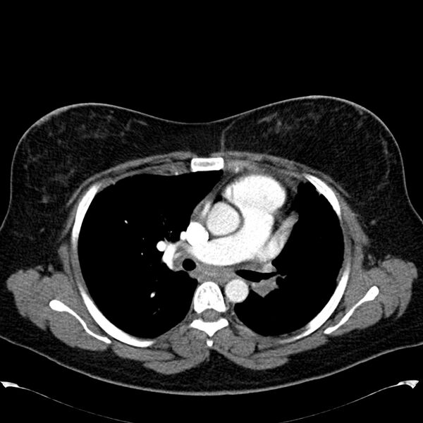 File:Chronic thromboembolic pulmonary hypertension (CTEPH) (Radiopaedia 74597-85531 Axial C+ CTPA 23).jpg