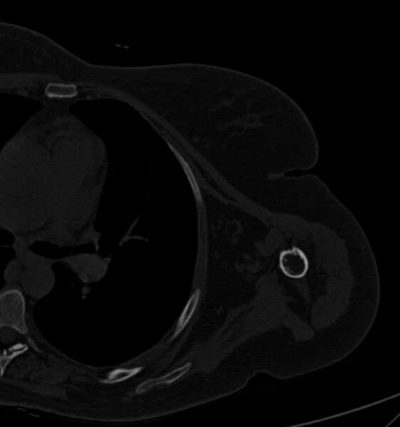 File:Clear cell chondrosarcoma - humerus (Radiopaedia 63104-71612 Axial bone window 77).jpg
