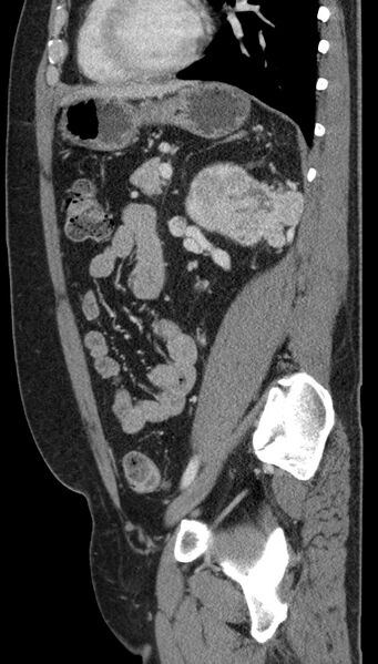 File:Clear cell renal cell carcinoma (Radiopaedia 61449-69393 G 35).jpg