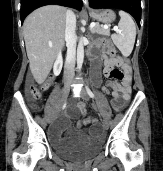 File:Closed loop small bowel obstruction (Radiopaedia 71211-81508 B 63).jpg