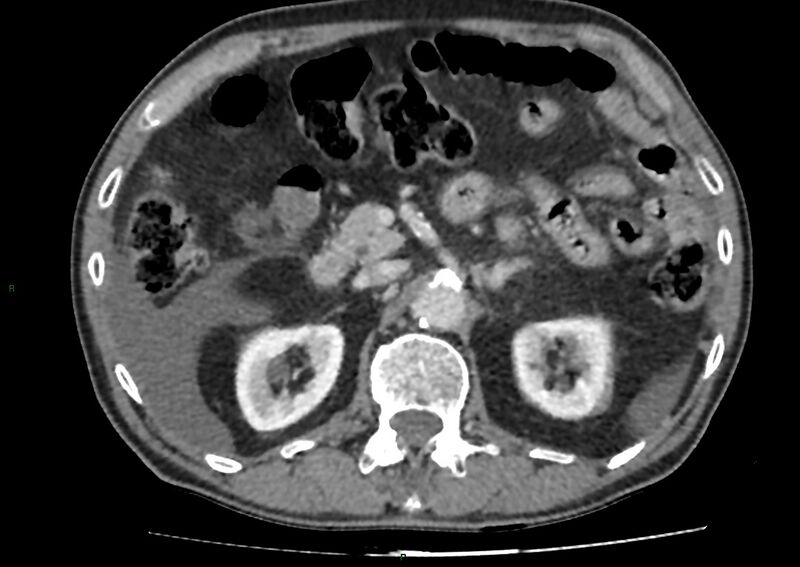 File:Closed loop small bowel obstruction with ischemia (Radiopaedia 84180-99456 A 40).jpg