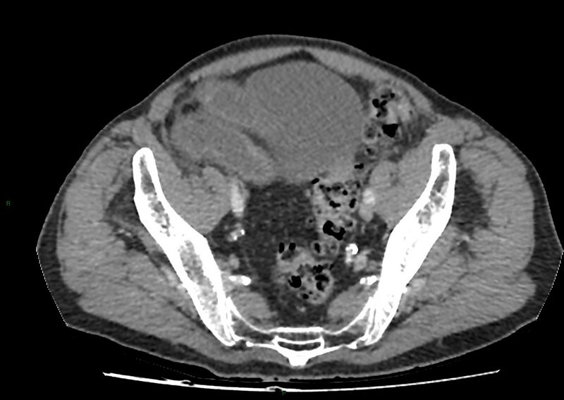 File:Closed loop small bowel obstruction with ischemia (Radiopaedia 84180-99456 A 98).jpg