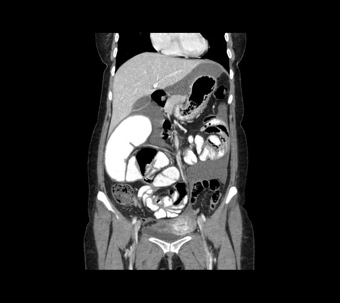 File:Cocoon abdomen with possible tubo-ovarian abscess (Radiopaedia 46235-50636 B 20).jpg