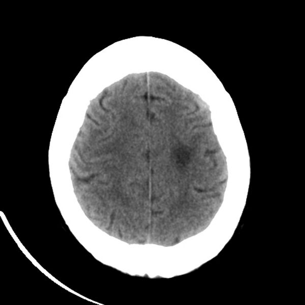 File:Colloid cyst with hydrocephalus (Radiopaedia 9373-10064 Axial non-contrast 15).jpg