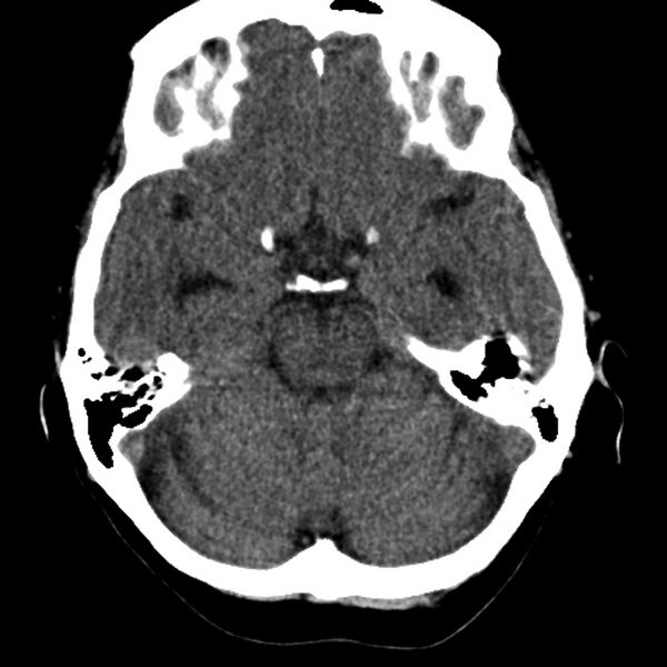 File:Colloid cyst with hydrocephalus (Radiopaedia 9373-10064 Axial non-contrast 7).jpg