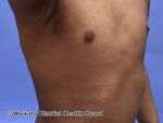 Follicular pattern of atopic dermatitis (DermNet NZ atopic-dermatitis-1).jpg