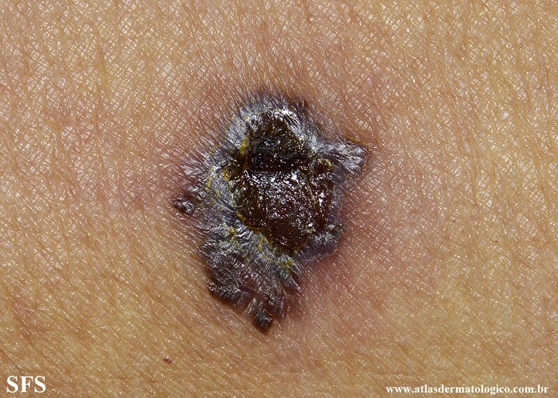 File:Melanoma (Dermatology Atlas 128).jpg