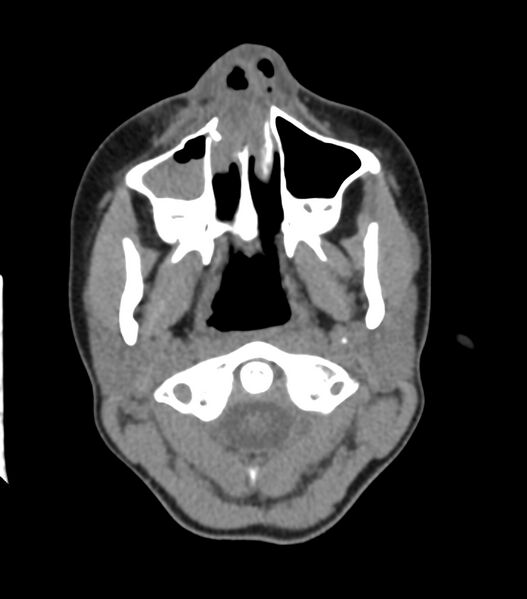 File:Nasoorbitoethmoid fracture (Radiopaedia 90044-107205 Axial non-contrast 110).jpg
