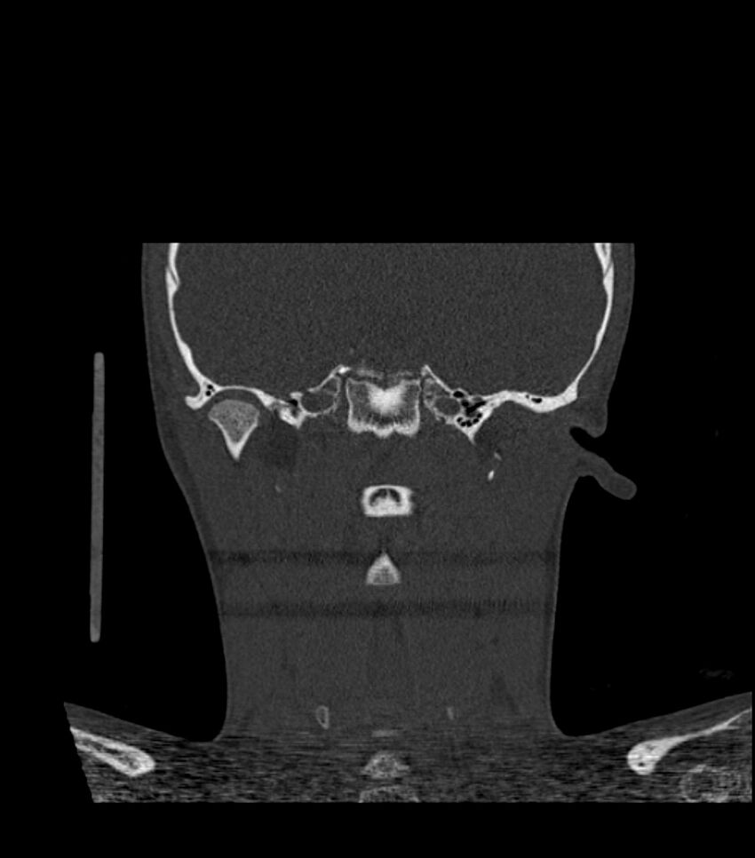 Nasoorbitoethmoid fracture (Radiopaedia 90044-107205 Coronal bone window 94).jpg