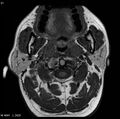 Nasopharyngeal carcinoma (Radiopaedia 4546-6667 Axial T1 13).jpg