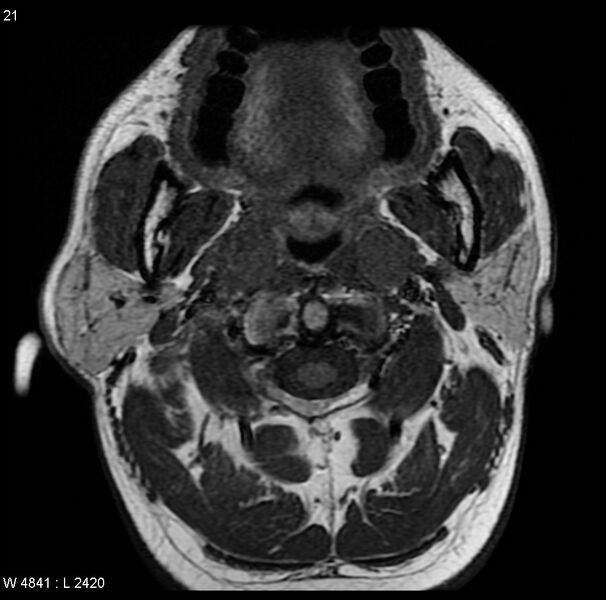 File:Nasopharyngeal carcinoma (Radiopaedia 4546-6667 Axial T1 13).jpg