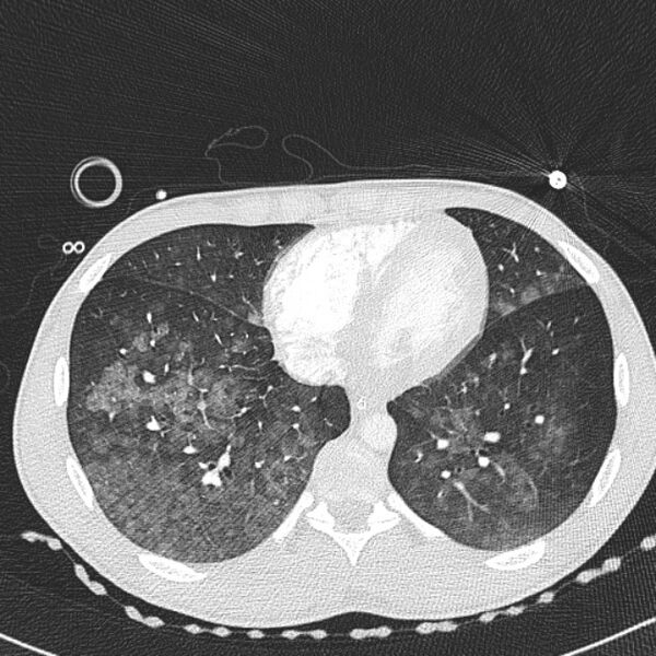 File:Near drowning (pulmonary edema) (Radiopaedia 24685-24958 lung window 58).jpg