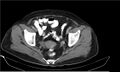 Necrotizing pancreatitis (Radiopaedia 20595-20495 Axial C+ delayed 41).jpg