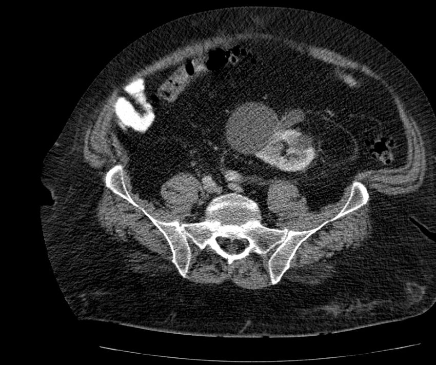Nephroptosis with inguinal hernia containing perirenal fat (Radiopaedia 56632-63391 C 247).jpg