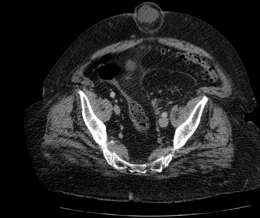 Nephroptosis with inguinal hernia containing perirenal fat (Radiopaedia 56632-63391 C 282).jpg