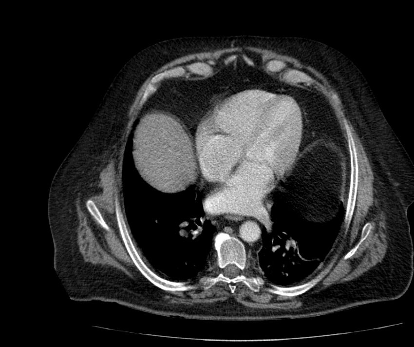 Nephroptosis with inguinal hernia containing perirenal fat (Radiopaedia 56632-63391 C 32).jpg