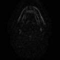Non-Hodgkin lymphoma - parotid gland (Radiopaedia 71531-81890 Axial DWI 5).jpg
