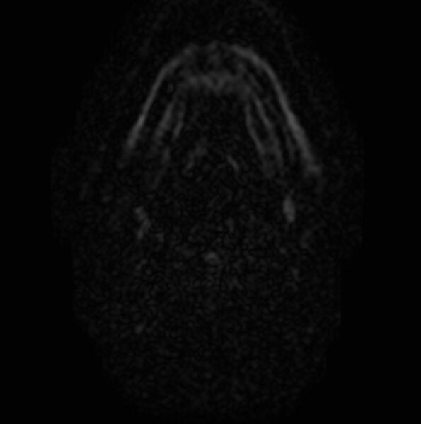 File:Non-Hodgkin lymphoma - parotid gland (Radiopaedia 71531-81890 Axial DWI 5).jpg