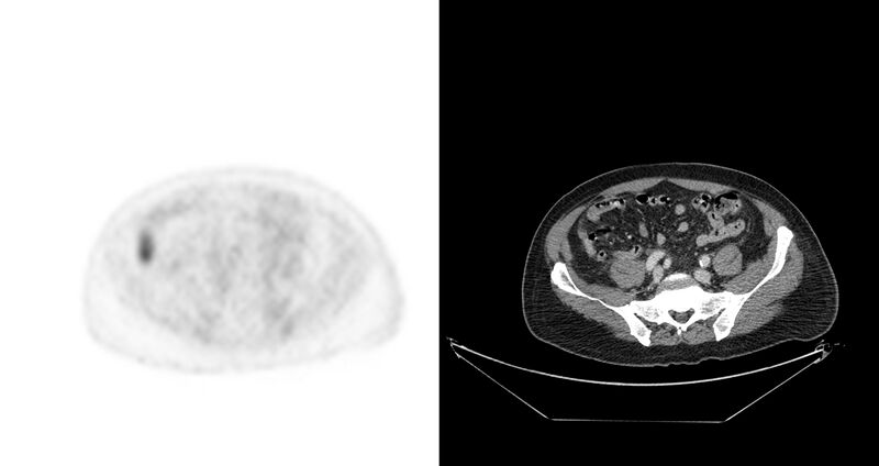 File:Non-Hodgkin lymphoma involving seminal vesicles with development of interstitial pneumonitis during Rituximab therapy (Radiopaedia 32703-33675 axial PET CT 17).jpg