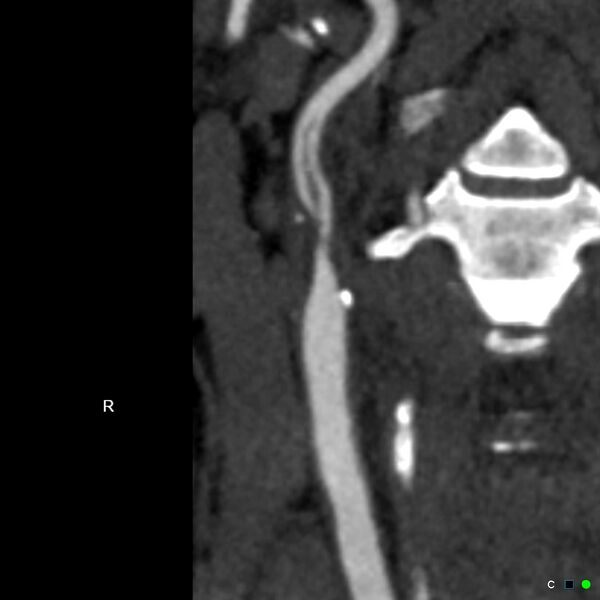 File:Non-occlusive intraluminal internal carotid artery thrombus (Radiopaedia 37751-39658 A 1).jpg