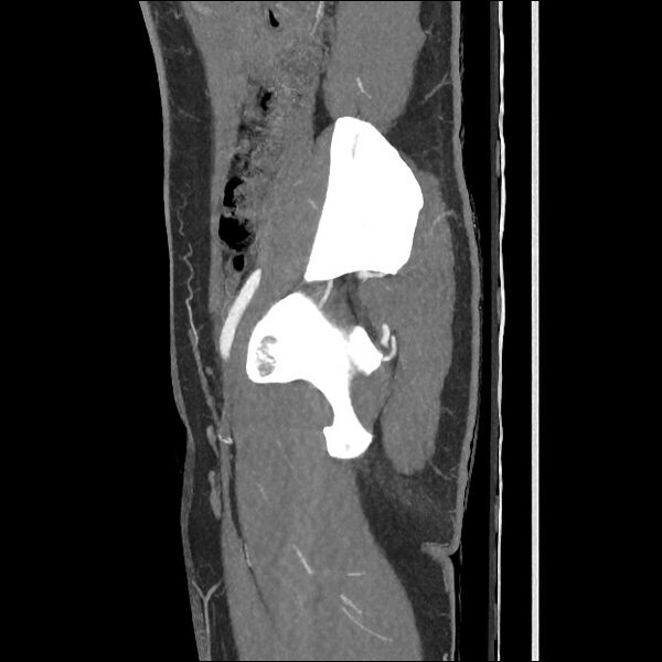 File:Normal CT angiogram of pelvis (Radiopaedia 45390-49430 C 49).jpg
