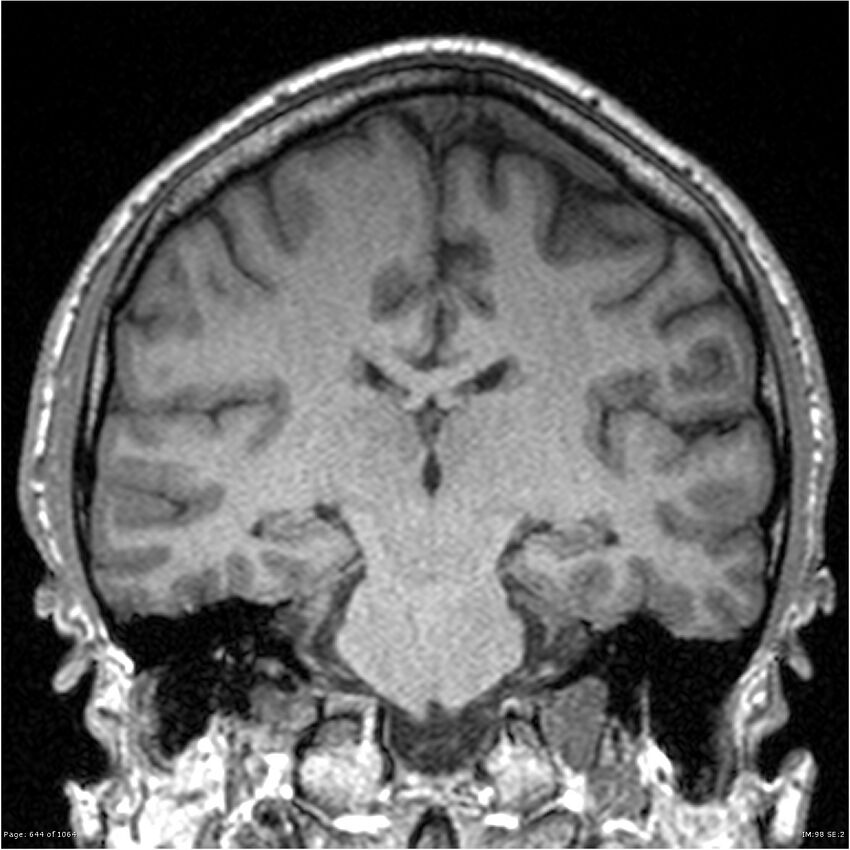 Normal brain MRI (non-focal epilepsy protocol) (Radiopaedia 38571-40700 Coronal T1 48).jpg