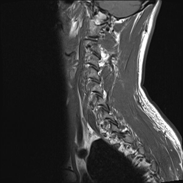 File:Normal cervical spine MRI (Radiopaedia 38418-40496 Sagittal T1 12).jpg