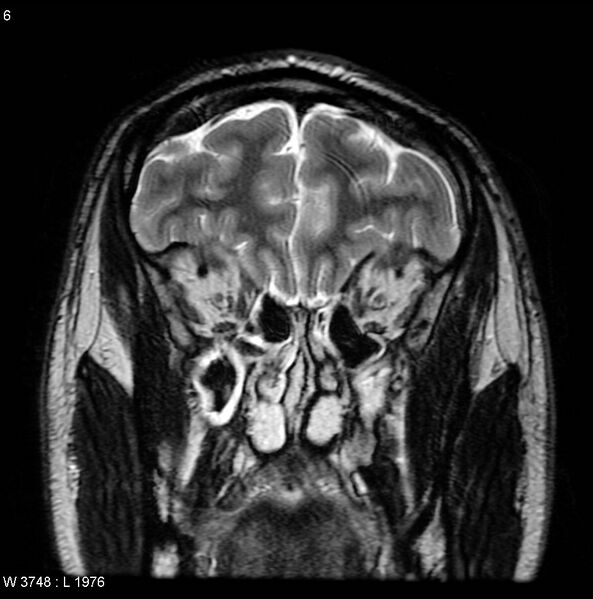File:Normal coronal brain (Radiopaedia 6676-7910 Coronal T2 6).jpg