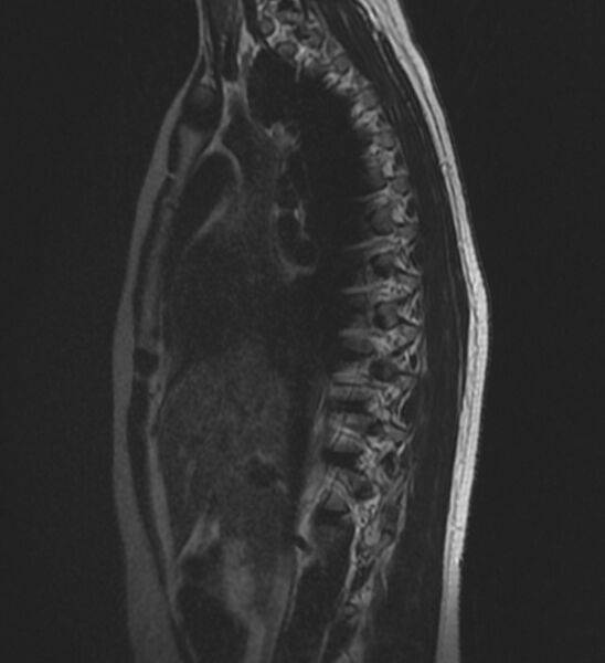 File:Normal thoracic spine MRI (Radiopaedia 41033-43781 Sagittal T2 3).jpg