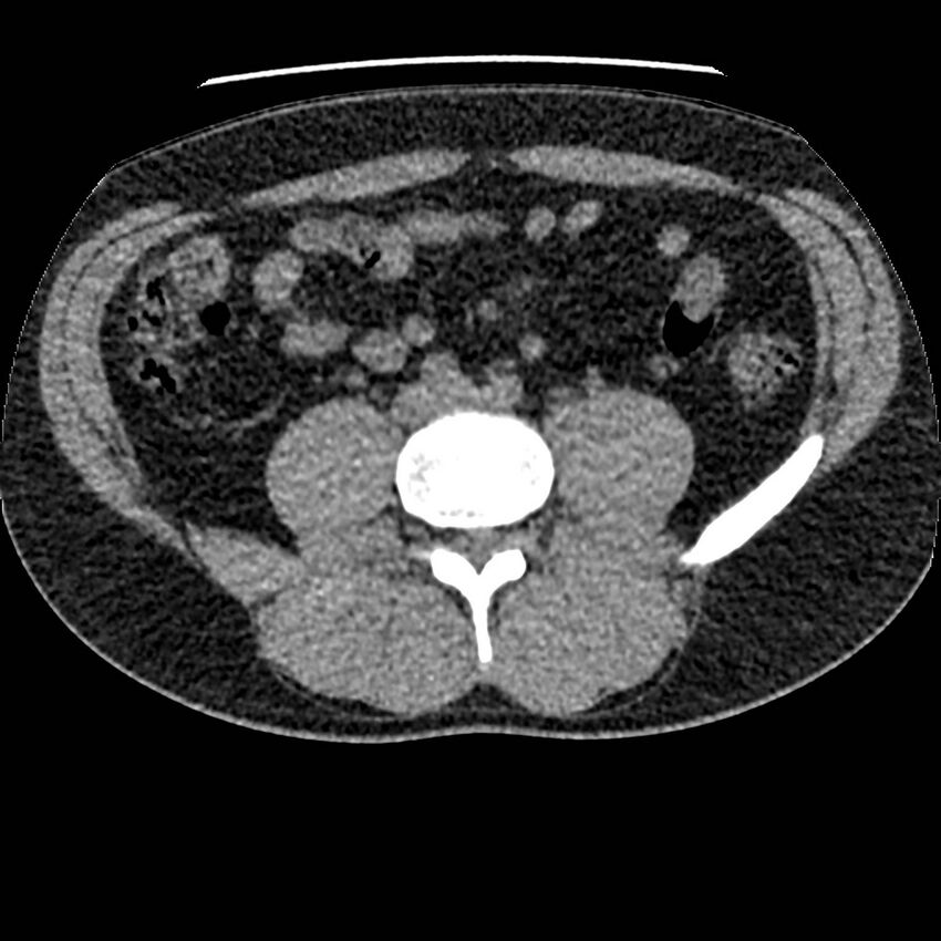 Obstructing ureteric calculus and ureteric anatomy (Radiopaedia 62730-71042 Axial non-contrast 88).jpg