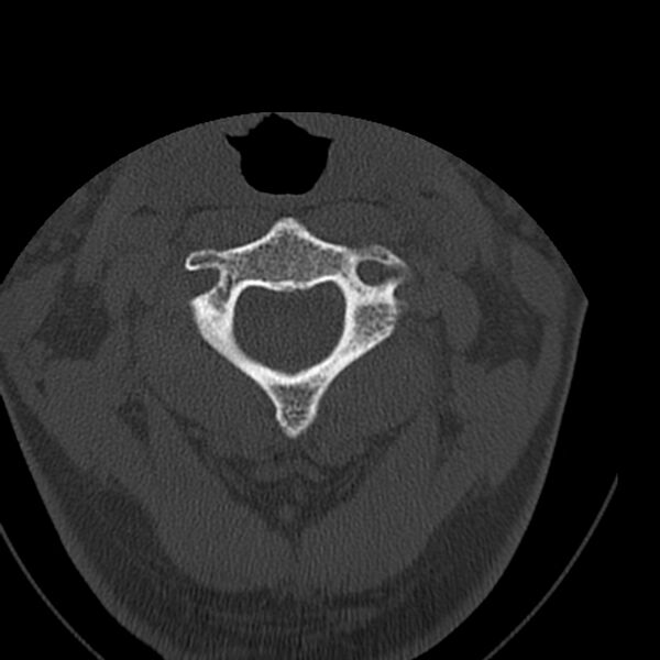 File:Occipital condyle fracture (Radiopaedia 31755-32691 Axial bone window 22).jpg