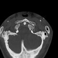 Occipital condyle fracture (Radiopaedia 31755-32691 Axial bone window 9).jpg