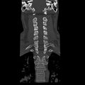Occipital condyle fracture (Radiopaedia 31755-32691 Coronal bone window 19).jpg