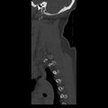 Occipital condyle fracture (Radiopaedia 31755-32691 Sagittal bone window 37).jpg