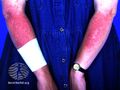 Sunscreen reaction (DermNet NZ dermatitis-acdss).jpg