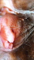 Vestibular papillomatosis close-up.png