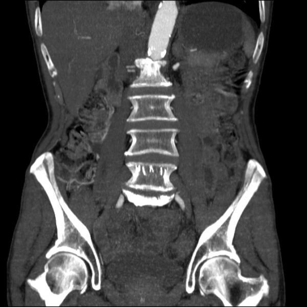 File:Abdominal aortic aneurysm (Radiopaedia 23703-23856 Coronal C+ arterial phase 16).jpg