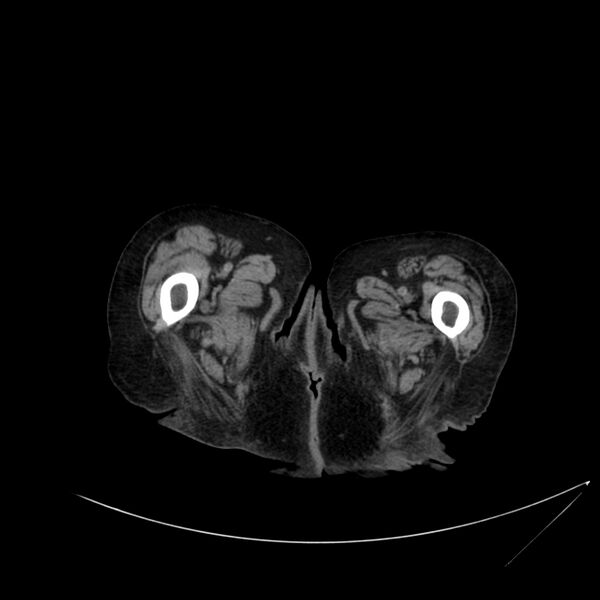 File:Abdominal aortic aneurysm - impending rupture (Radiopaedia 19233-19246 Axial non-contrast 147).jpg