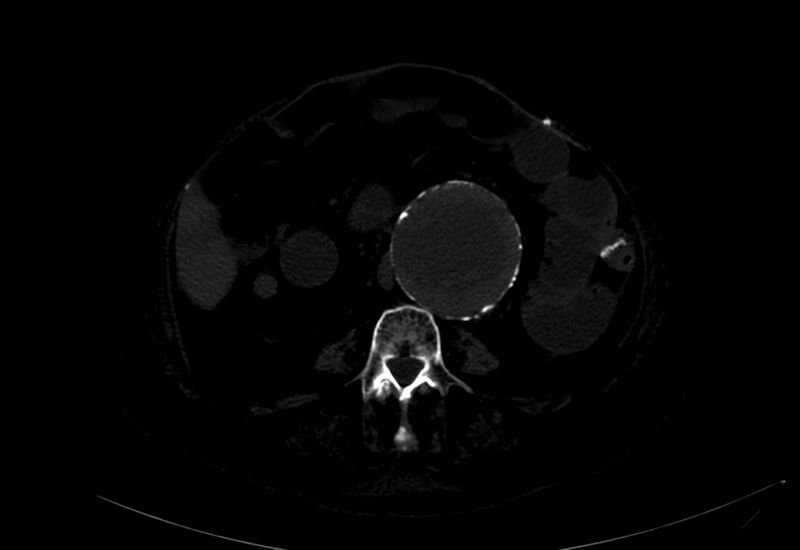 File:Abdominal aortic aneurysm - impending rupture (Radiopaedia 19233-19246 B 22).jpg