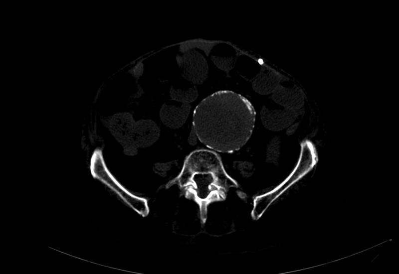 File:Abdominal aortic aneurysm - impending rupture (Radiopaedia 19233-19246 B 31).jpg