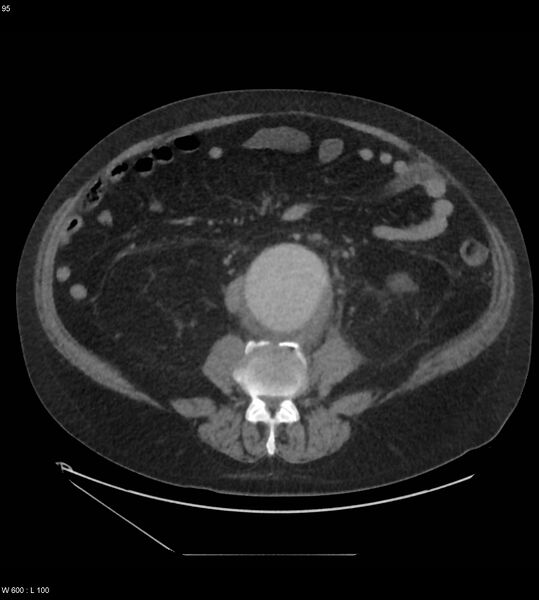 File:Abdominal aortic aneurysm with intramural hematoma then rupture (Radiopaedia 50278-55631 Axial C+ arterial phase 86).jpg