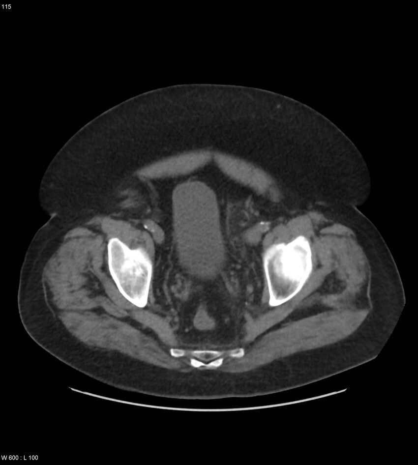 Abdominal aortic aneurysm with intramural hematoma then rupture (Radiopaedia 50278-55631 Axial non-contrast 111).jpg